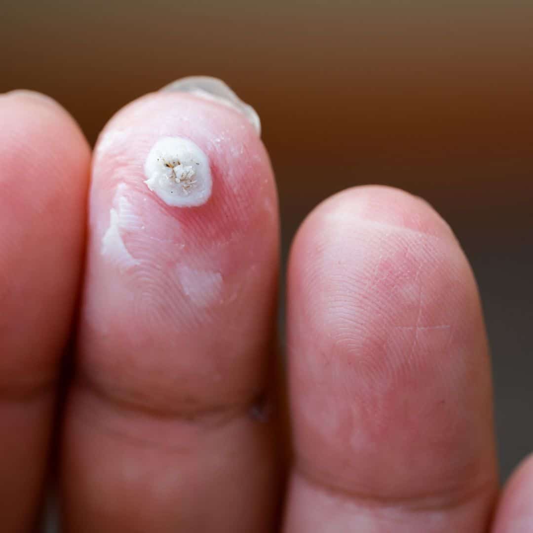 Common wart on a fingertip, white and softened from treatment, with tiny dark dots on its surface.