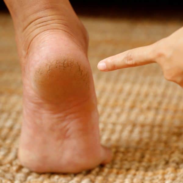 Finger pointing to painful hard skin and callus on the heel of a foot.
