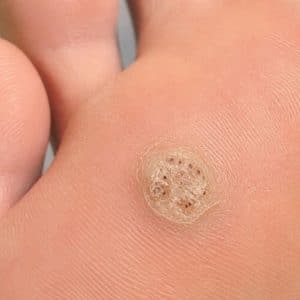 Close-up of a verruca on the sole of a foot, showing the rough skin and dark dots typical of verrucas and warts.